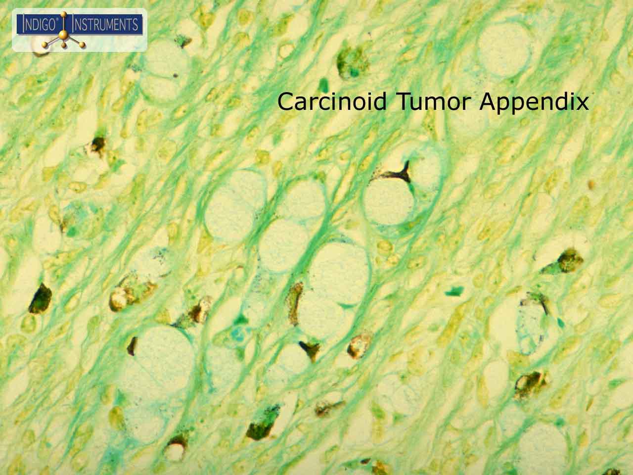 Carcinoid Tumor Appendix