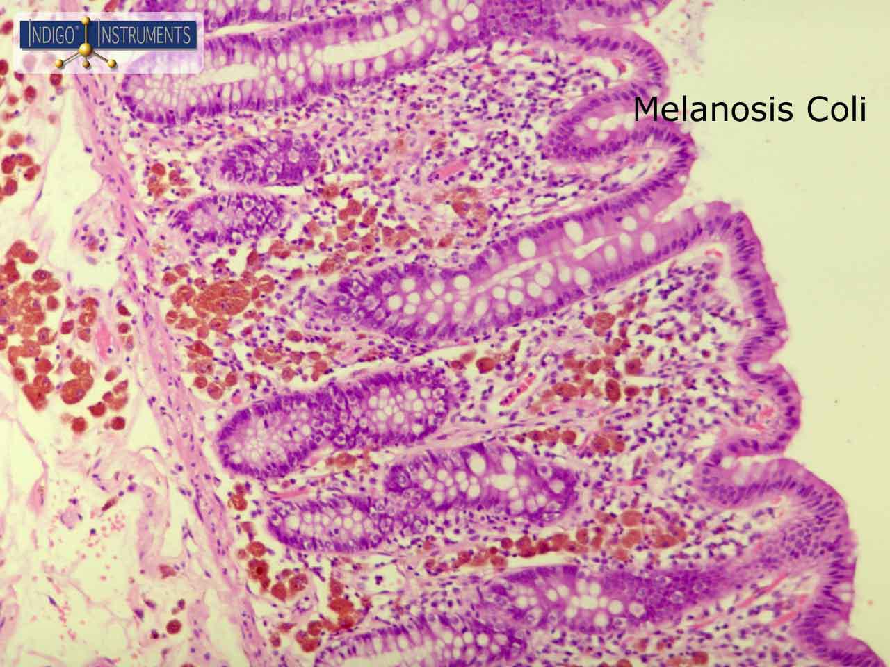 Melanosis coli